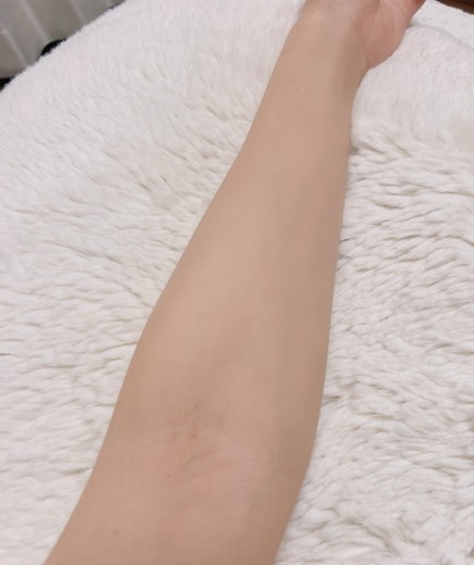 after photo: 美容注射・点滴