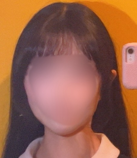 after photo: 脂肪溶解注射(腕), 脂肪溶解注射(顔)