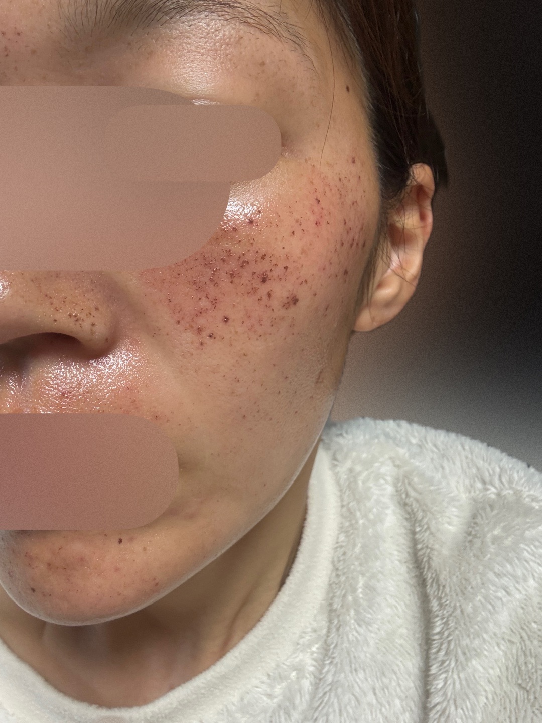 ハイドラフェイシャル（全顔）＋ルメッカ | 大美会クリニック 神戸院