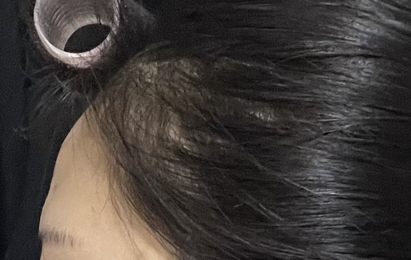 before photo: 이마필러