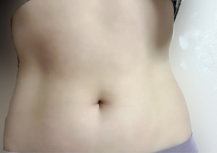 after photo: 脂肪冷却(腹部)
