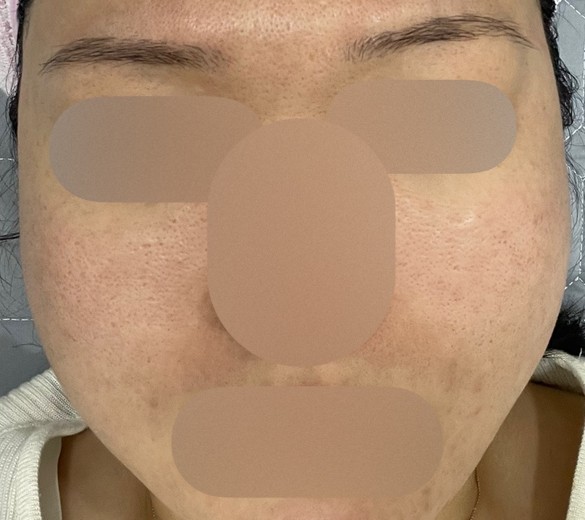 after photo: 여드름주사, 네오빔