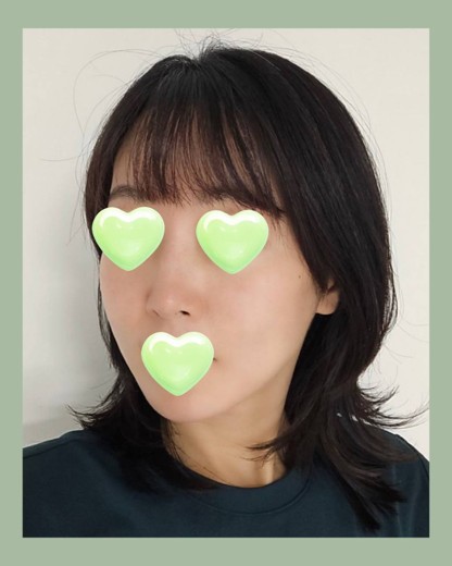 after photo: 티타늄리프팅