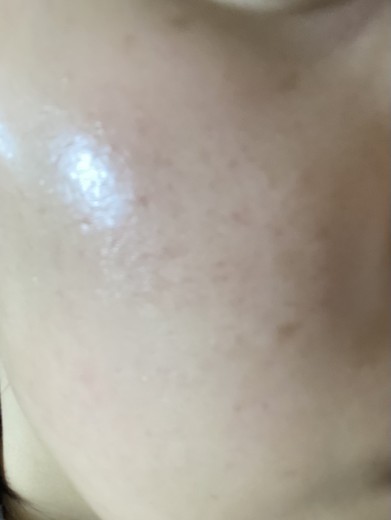 after photo: イオン導入