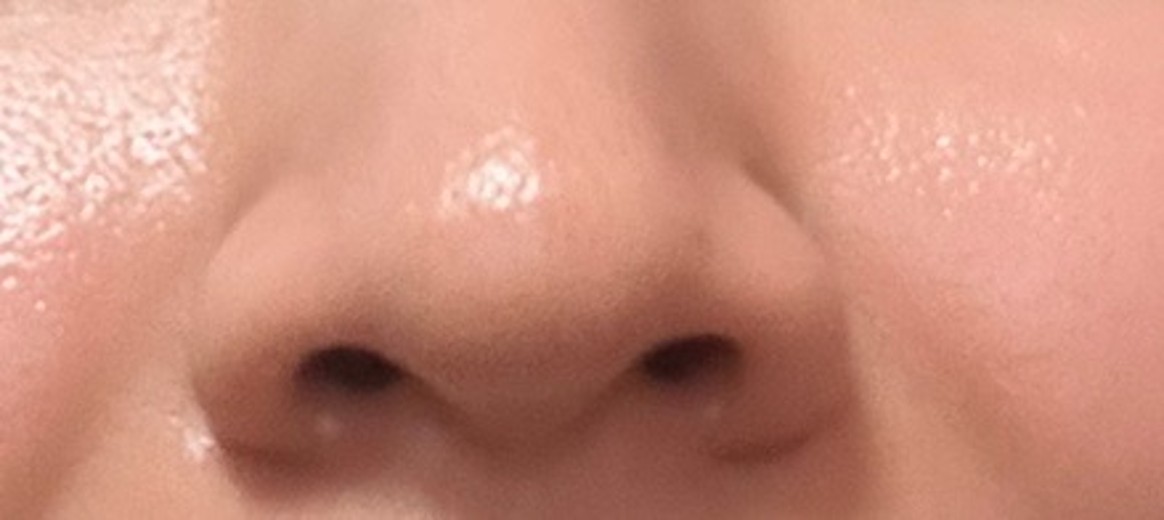 after photo: 脂肪溶解注射(顔)