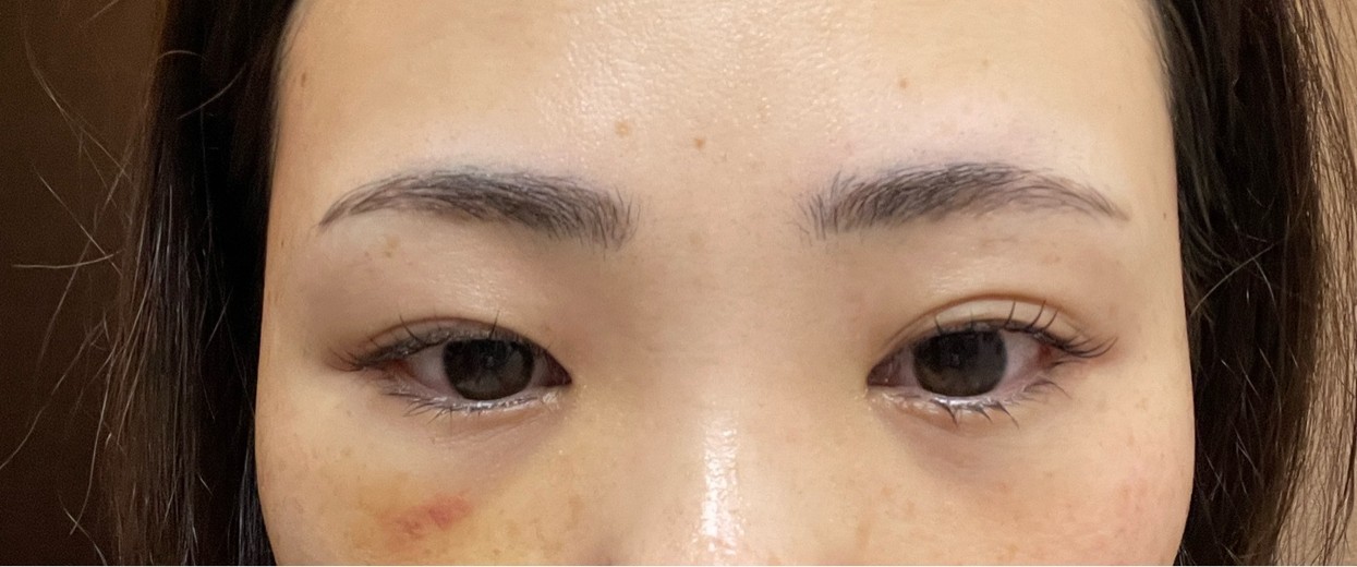 after photo: 脱脂(クマ治療)