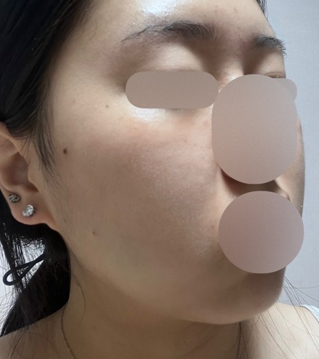 after photo: 윤곽주사, 얼굴지방분해주사