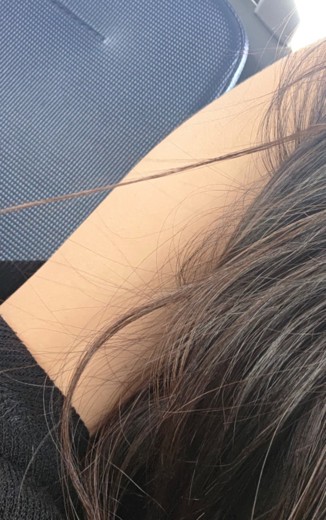 after photo: 팔지방분해주사