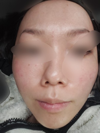 after photo: 水光注射