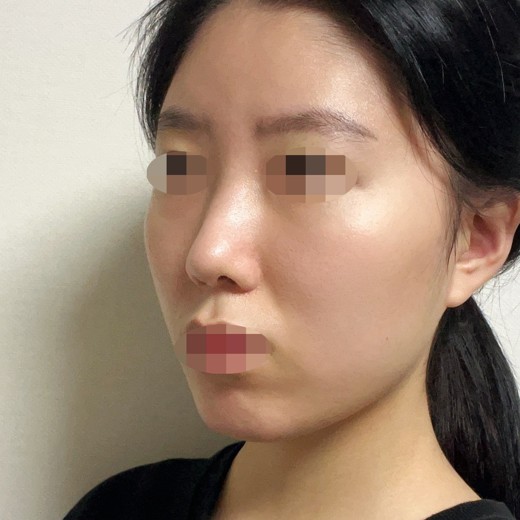 after photo: 코끝(자가연골)