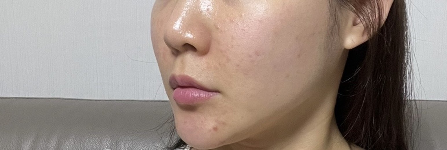 after photo: PRP피부재생술