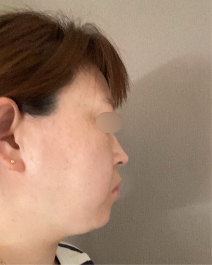 before photo: 脂肪溶解注射(腕), 脂肪溶解注射(顔)