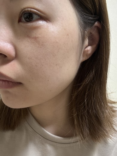 after photo: ダーマペン, エクソソーム