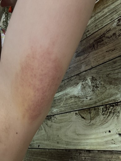 after photo: 脂肪冷却(腕)