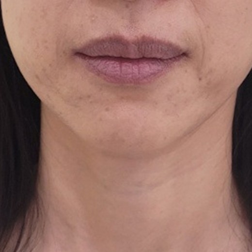 before photo: 입술축소술