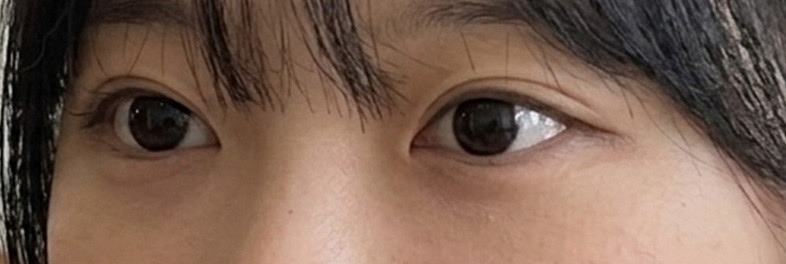시술 후