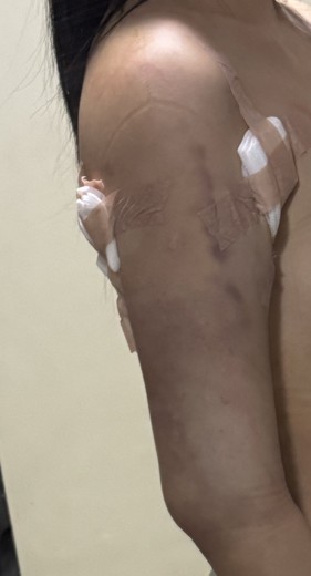 after photo: 복부지방흡입