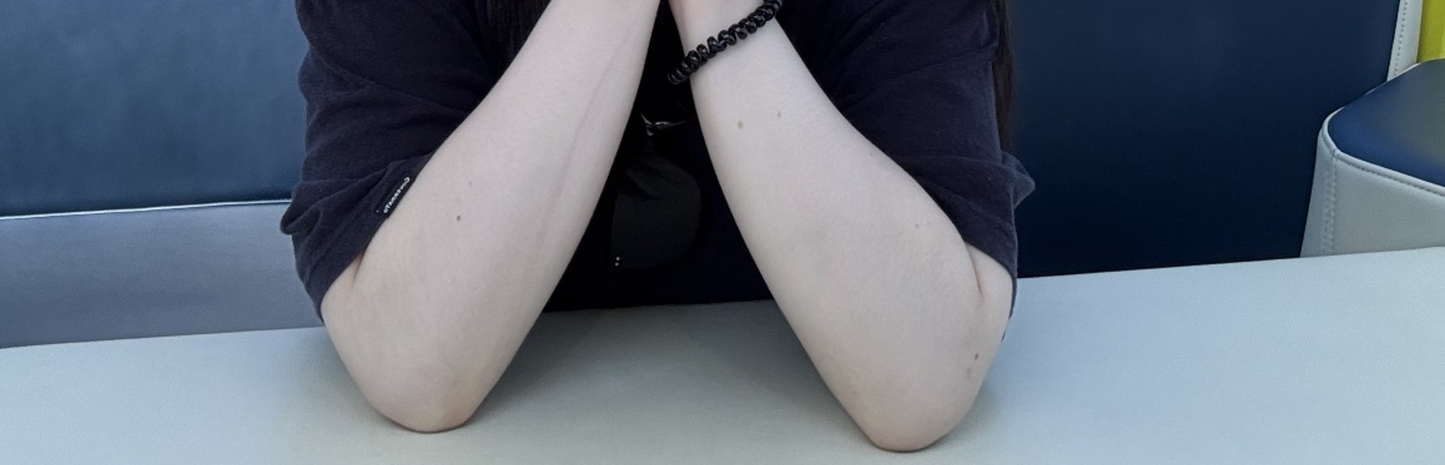 after photo: 脂肪吸引(腕)