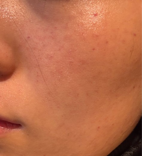 after photo: 水光注射, 診断・検査