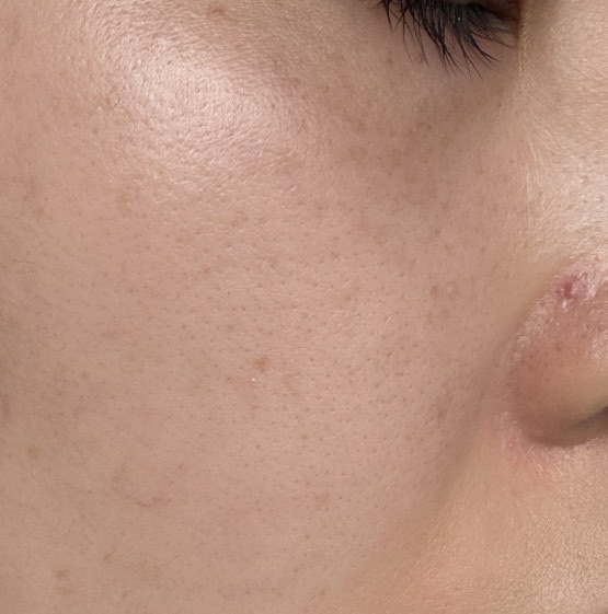 エレクトロポレーション【再来OK】 | ライズワン美容皮膚科クリニック