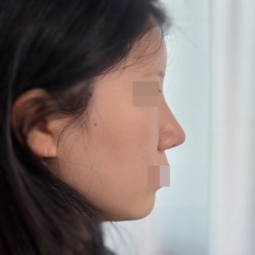 after photo: 코재수술, 콧대(보형물), 복코교정(수술)