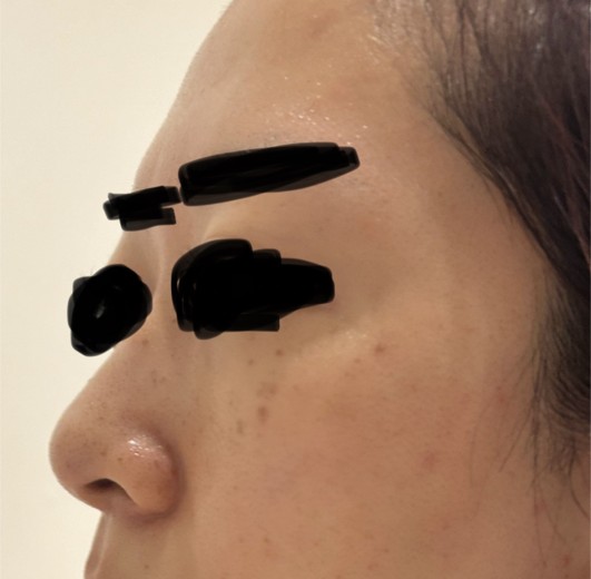 after photo: フラクショナルレーザー, エレクトロポレーション