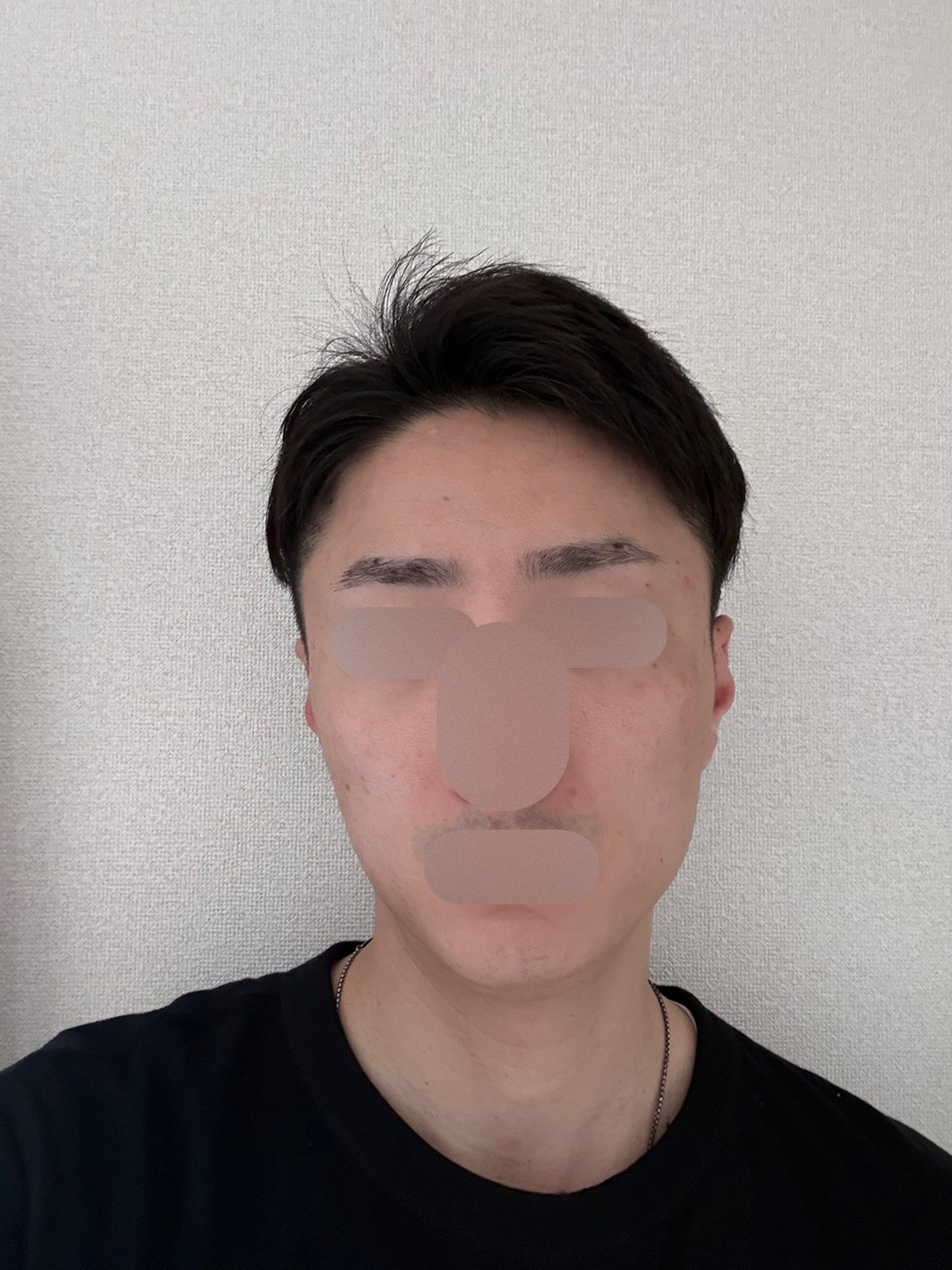 何度でも可】【男性限定】ヒゲ脱毛（髭全体）｜ジェントルマックスプロ