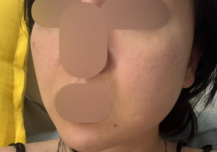 after photo: PRP피부재생술