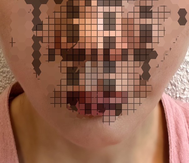 after photo: 糸リフト