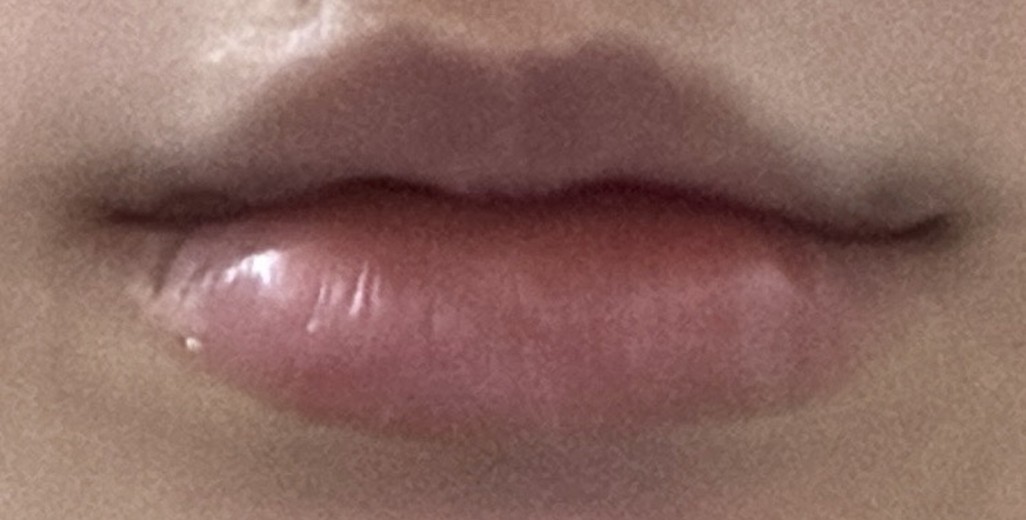 after photo: 입꼬리필러, 입꼬리보톡스, 입술필러