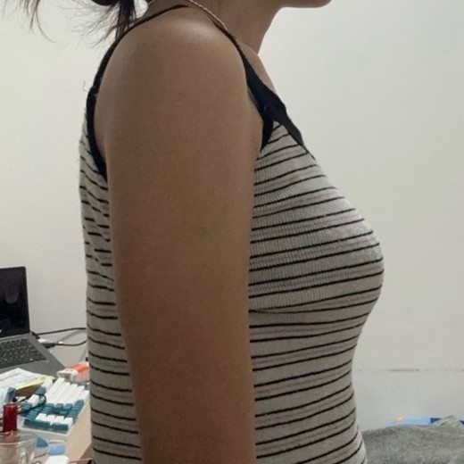 after photo: 脂肪溶解注射(腕)