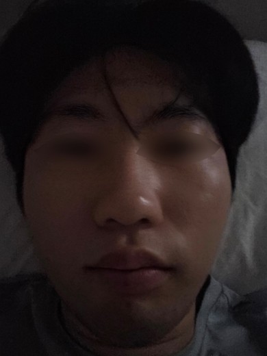 after photo: 아쿠아필링