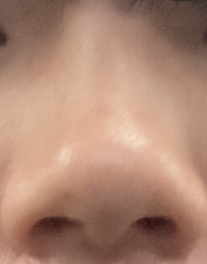 after photo: 脂肪溶解注射(顔)