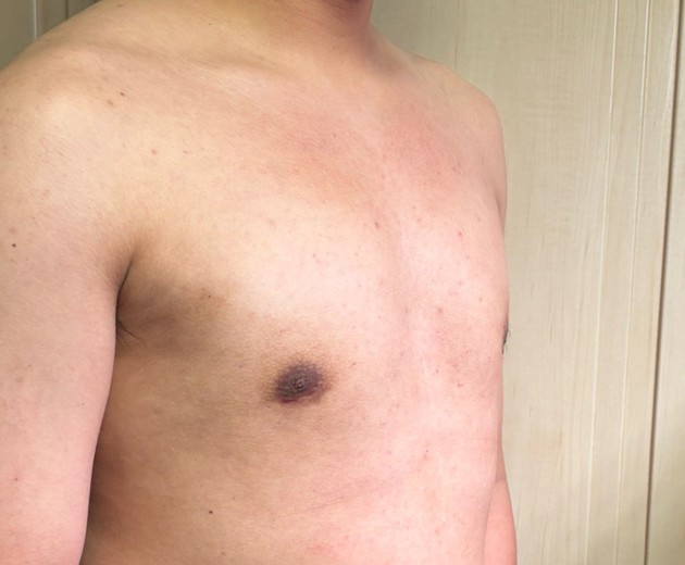 after photo: 여유증수술