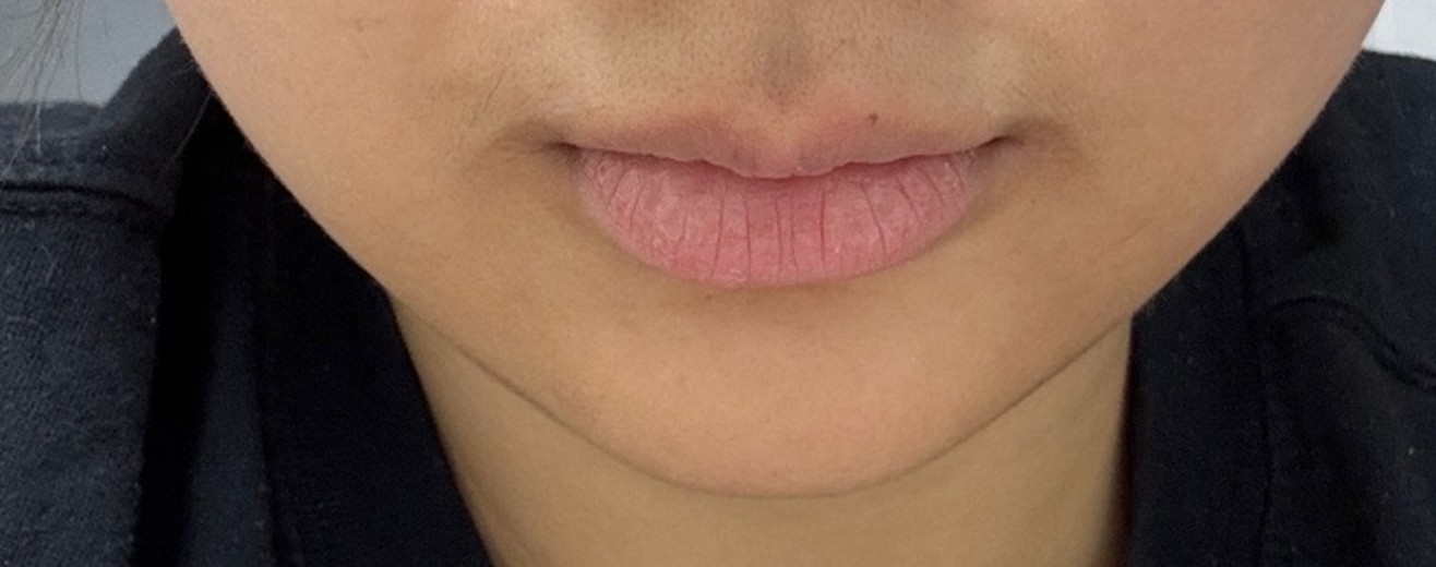 before photo: 입술필러