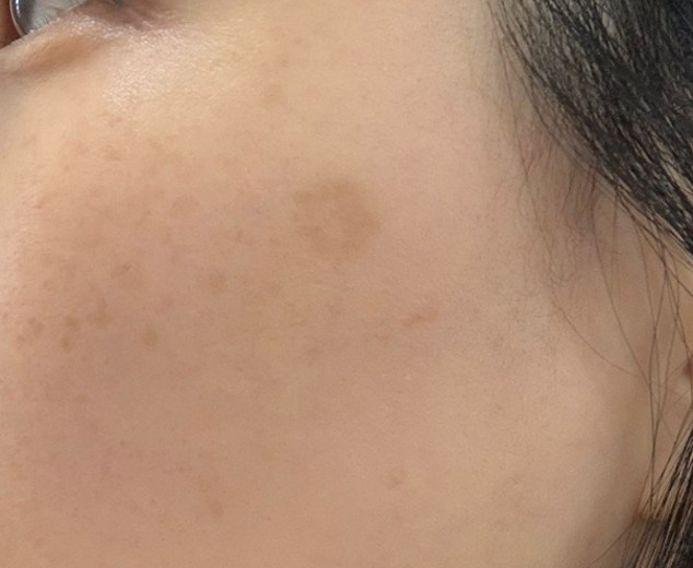 before photo: 리팟레이저