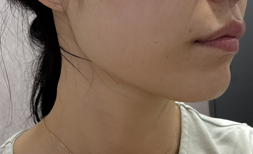 after photo: 사각턱보톡스, 튠라이너