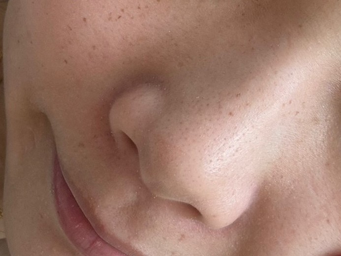 before photo: IPL(光/フォト治療), 診断・検査