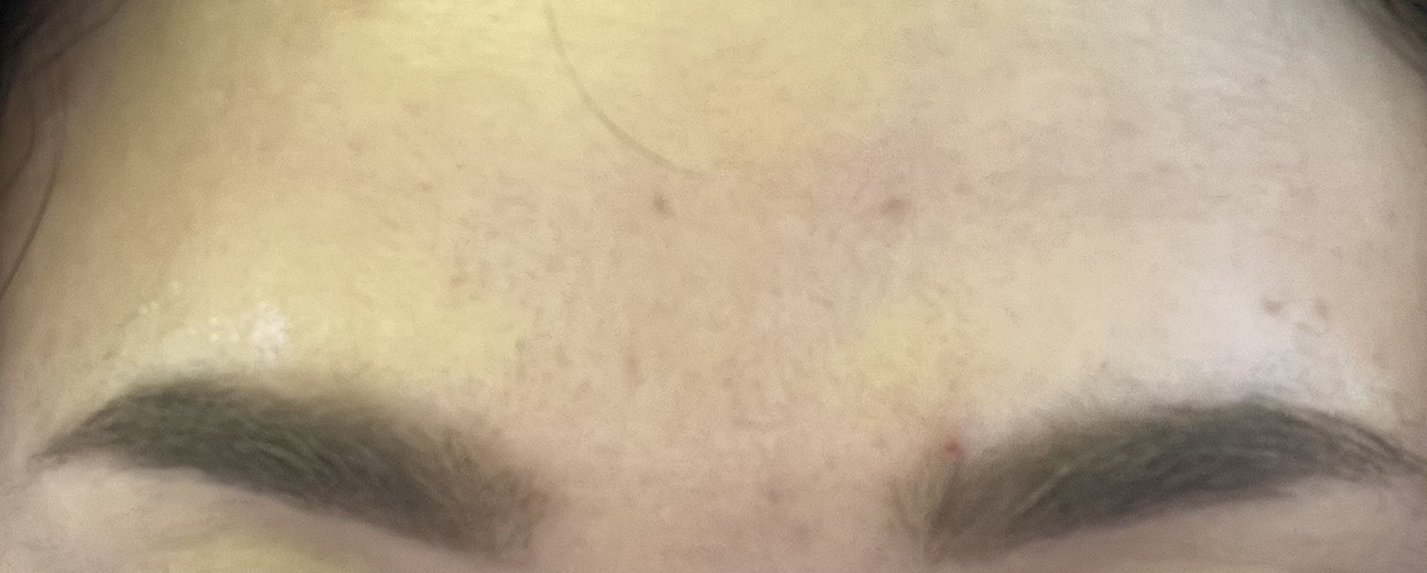 after photo: 사각턱보톡스