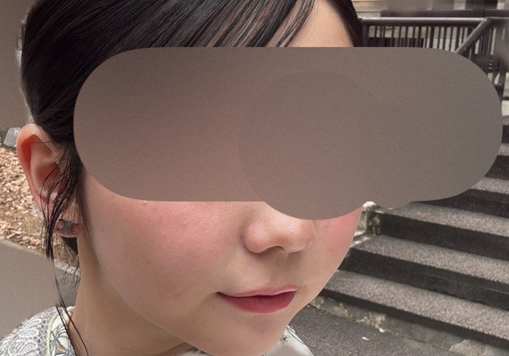 before photo: ピコトーニング