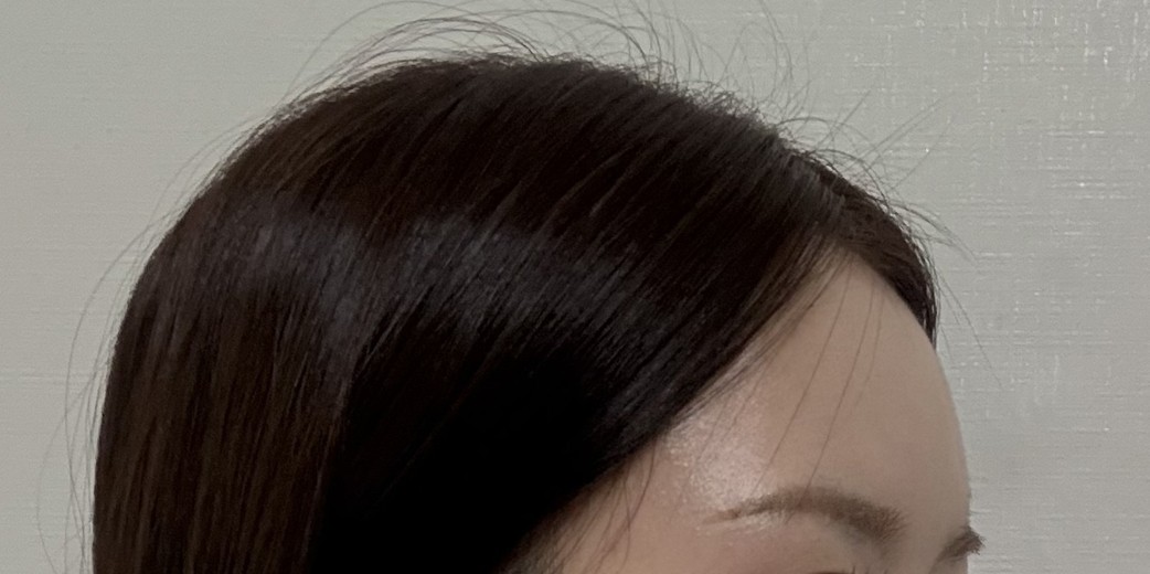 after photo: 이마필러