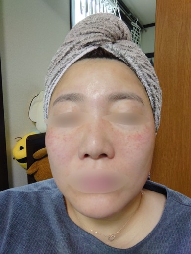 after photo: ダーマペン