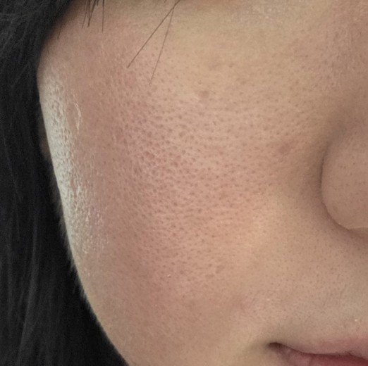 after photo: 리쥬란힐러, 쥬베룩