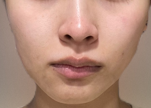 エレクトロポレーション エレクトロポレーション（全顔） | アステリアクリニック