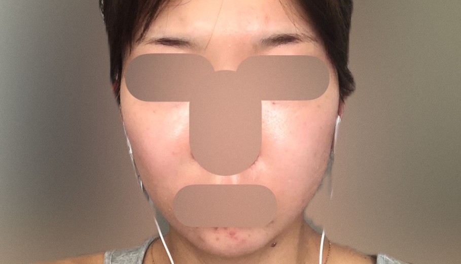 after photo: IPL(光/フォト治療)