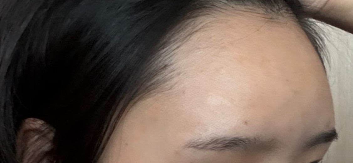 after photo: 이마필러, 관자놀이필러