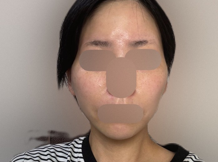 after photo: 糸リフト