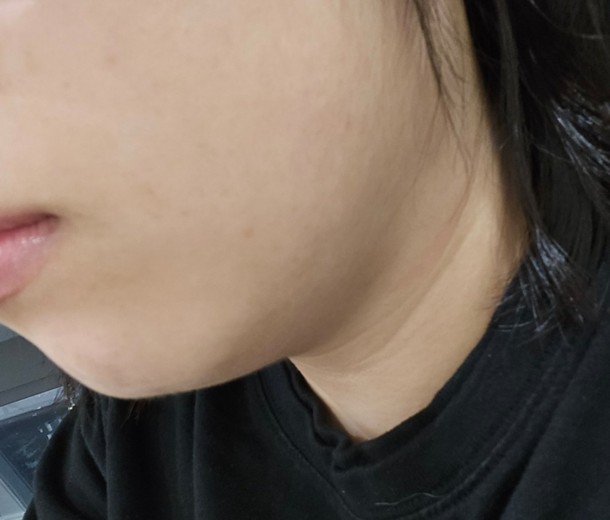 before photo: 사각턱보톡스, 튠라이너