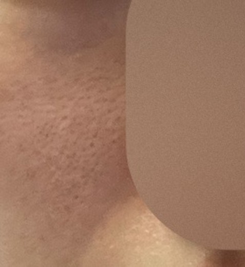 after photo: 리쥬란힐러