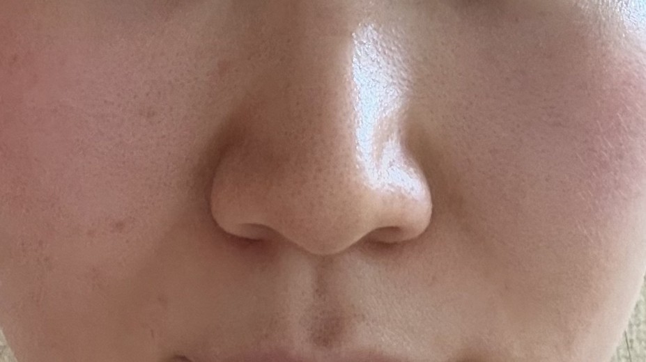 after photo: 脂肪溶解注射(顔)